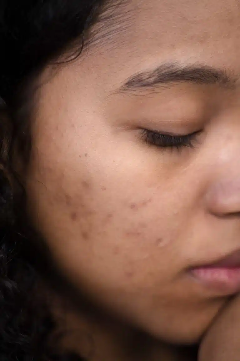 Fungal Acne vs Hormonal Acne: 3 Signs It May Not Be Acne